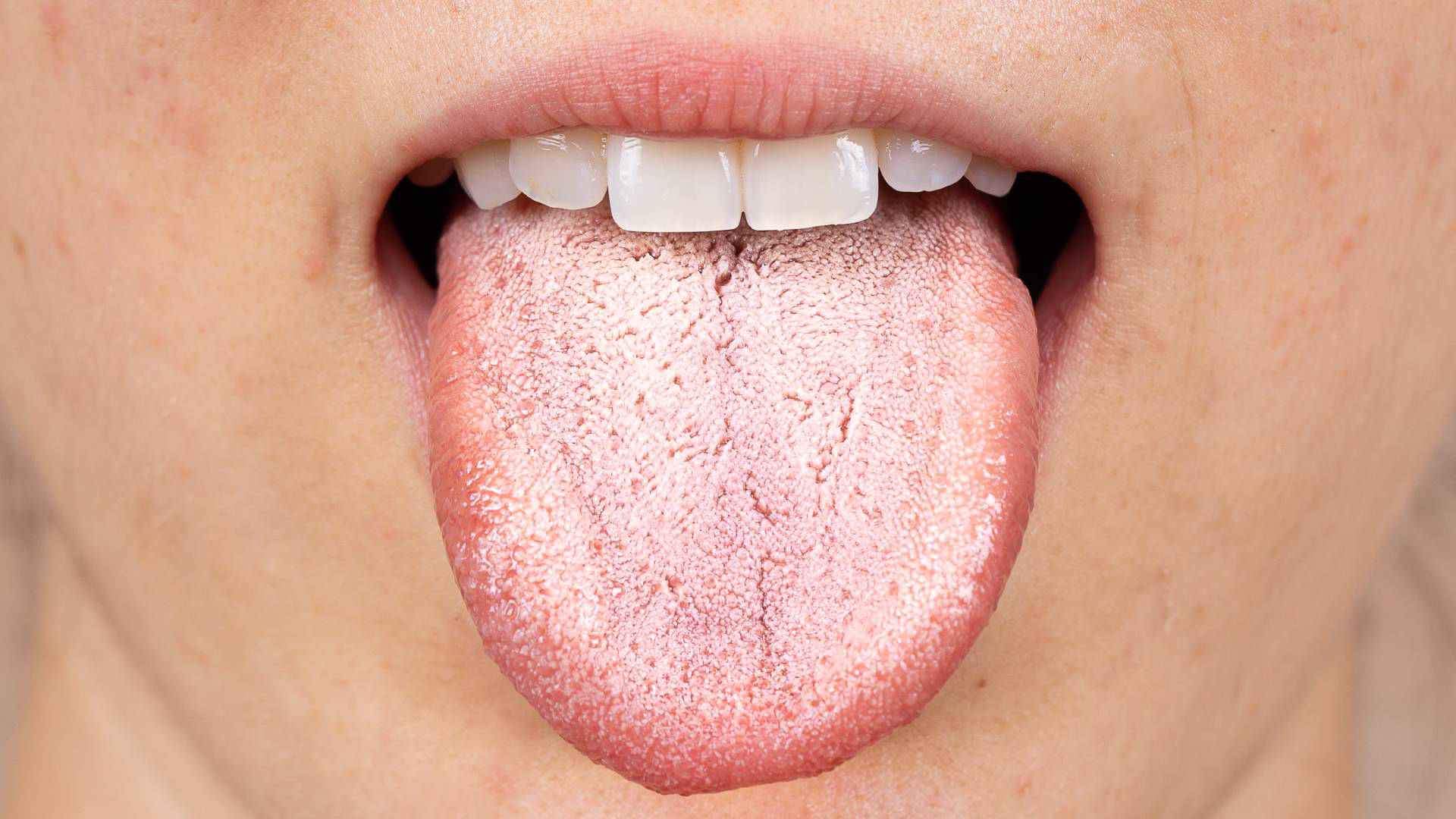 vapers tongue what is it and how is it caused?